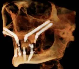 Advanced Center for Oral Surgery and Dental Implants - Dr. Spiro Karras & Dr. Maria Karras
