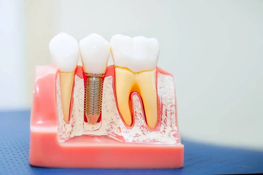 Precision Oral Surgery and Implants