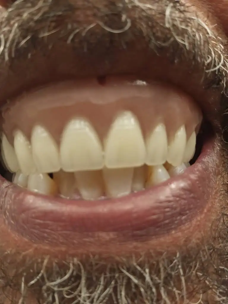 Affordable Dentures & Implants