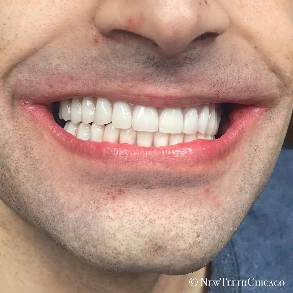 New Teeth Chicago Dental Implant Center & Allon4 Implant Centers