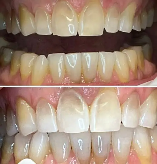 We Whiten Teeth Whitening