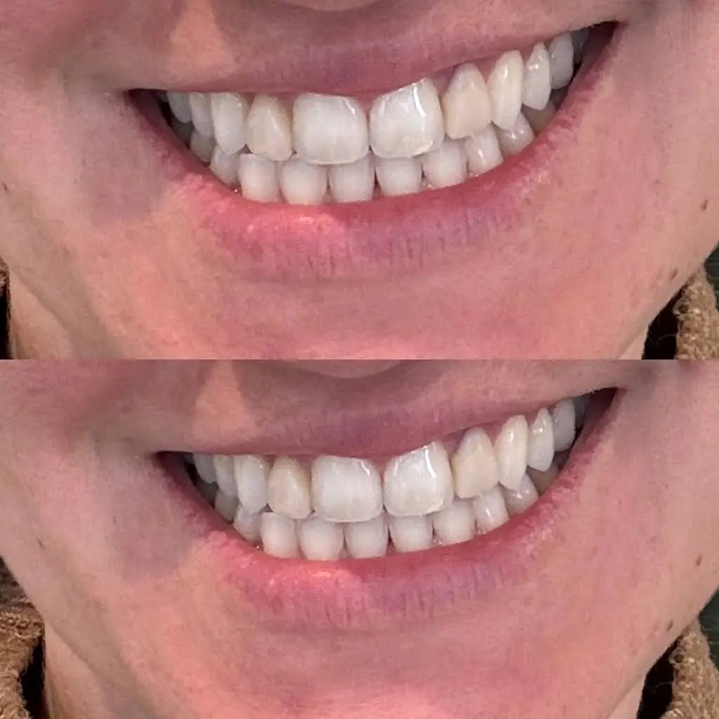 We Whiten Teeth Whitening