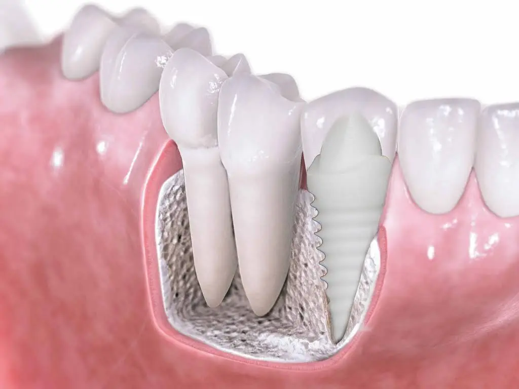 Maryland Sedation Dentist
