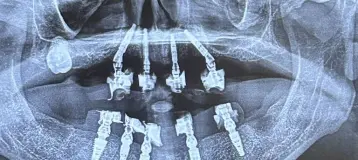 Affordable Dentures & Implants