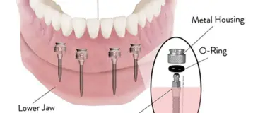 Mini Dental Implant Solutions Homewood, IL