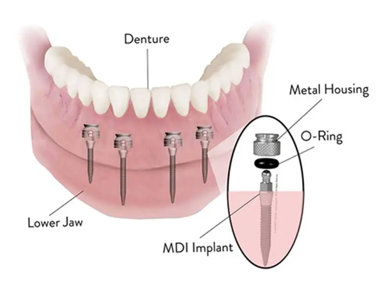 Mini Dental Implant Solutions Homewood, IL