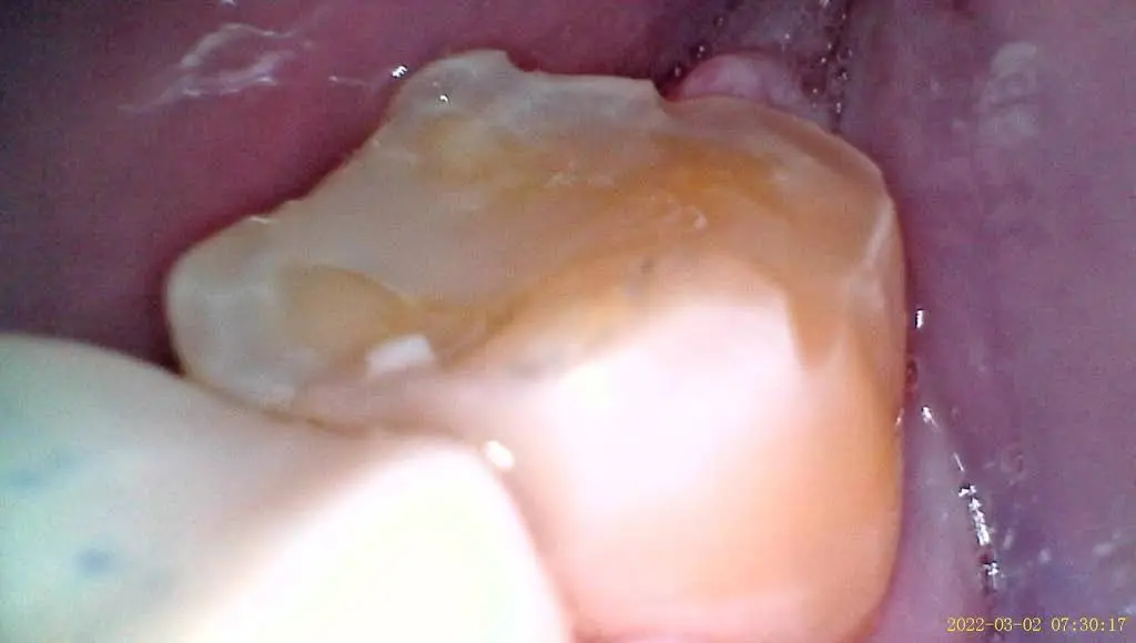 Munster Dental Center - Dr. Jim Frankos D.D.S.
