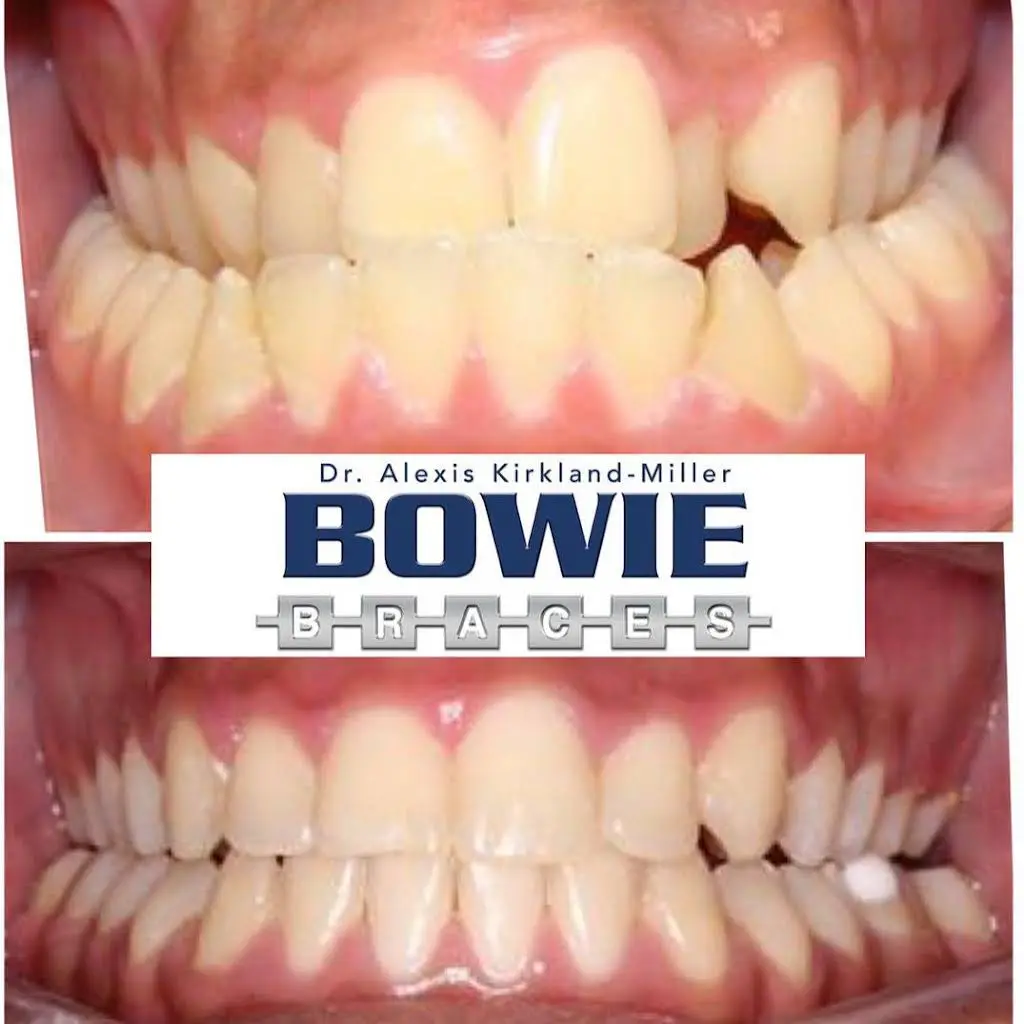 Bowie Braces