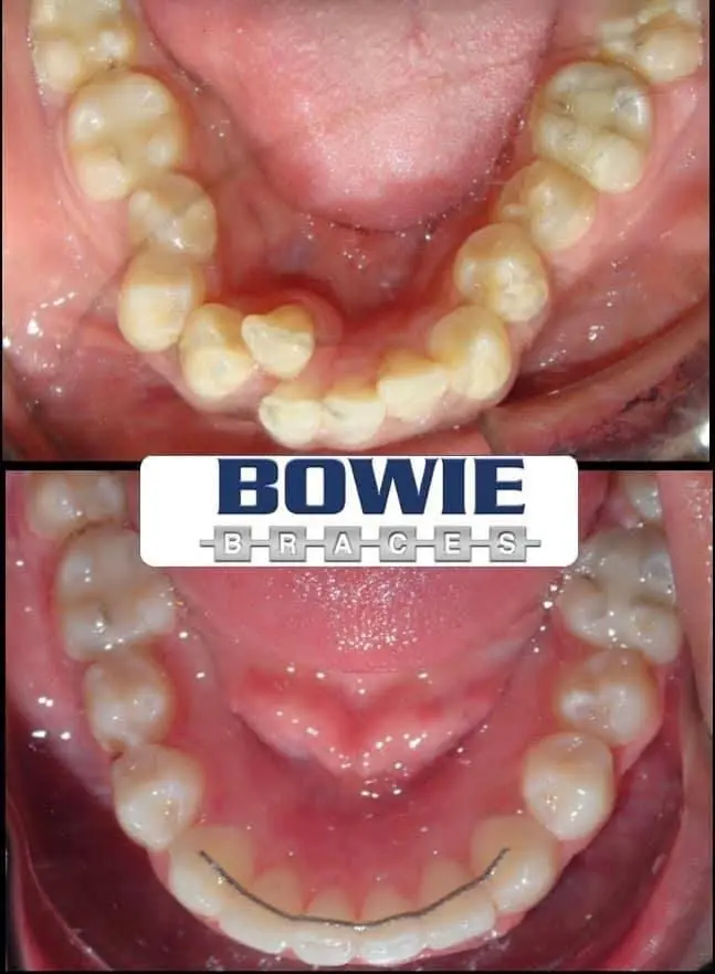 Bowie Braces