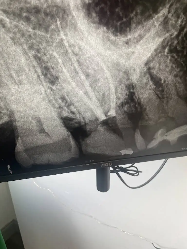 RCT Endodontics Bowie