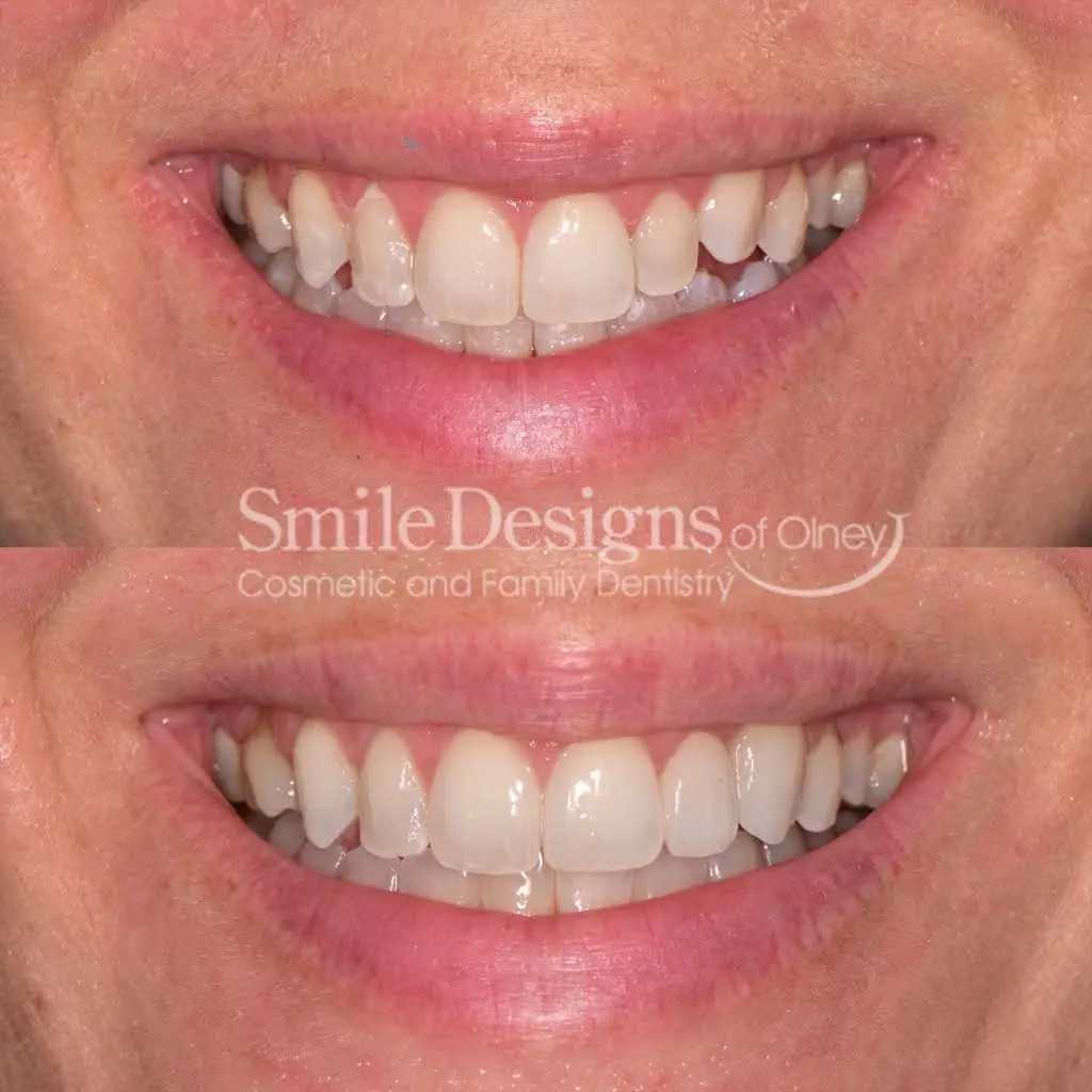 Smile Designs of Olney - Mitchell A. Lomke, DDS & Joshua M. Lomke, DDS