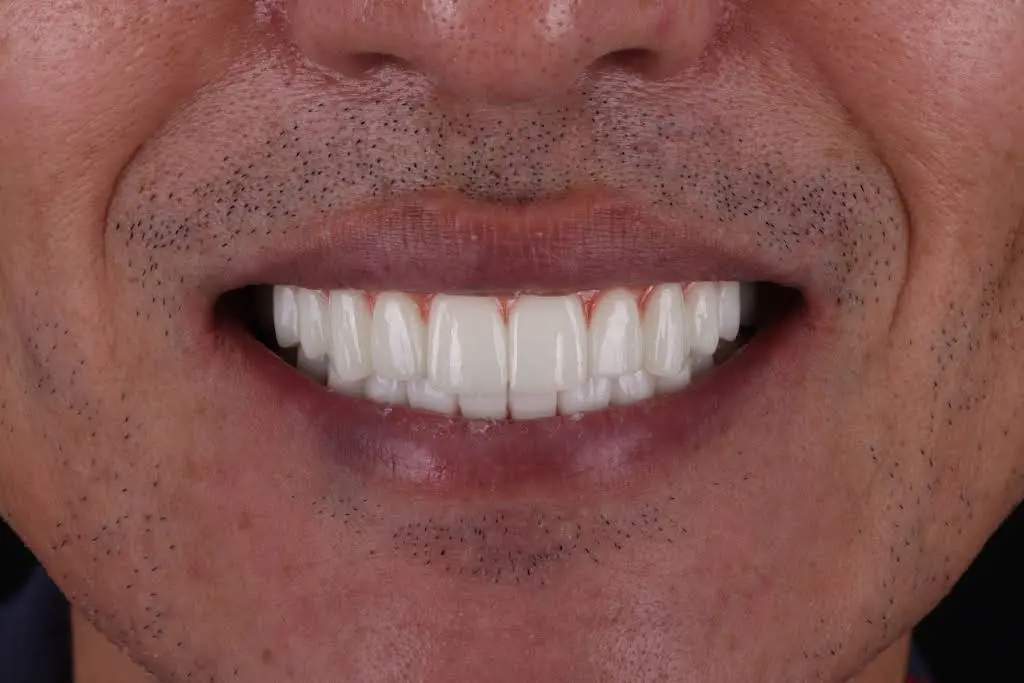 Smart Arches Dental Implants - Rockville