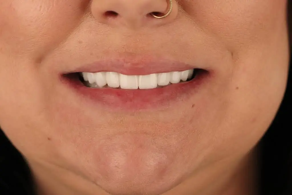 Smart Arches Dental Implants - Rockville
