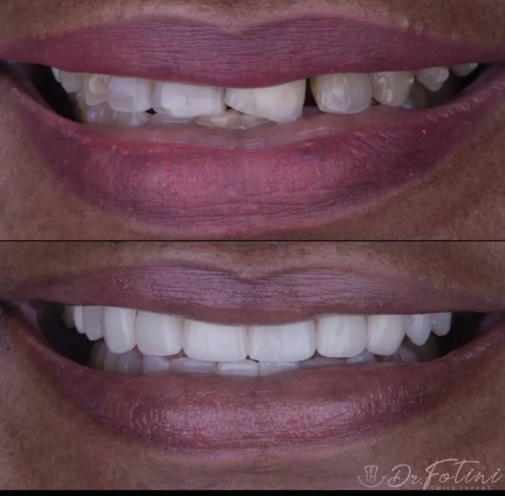 Fotini Chrisopoulos DDS, MS- Prosthodontist | Cosmetic & Implant Dentistry