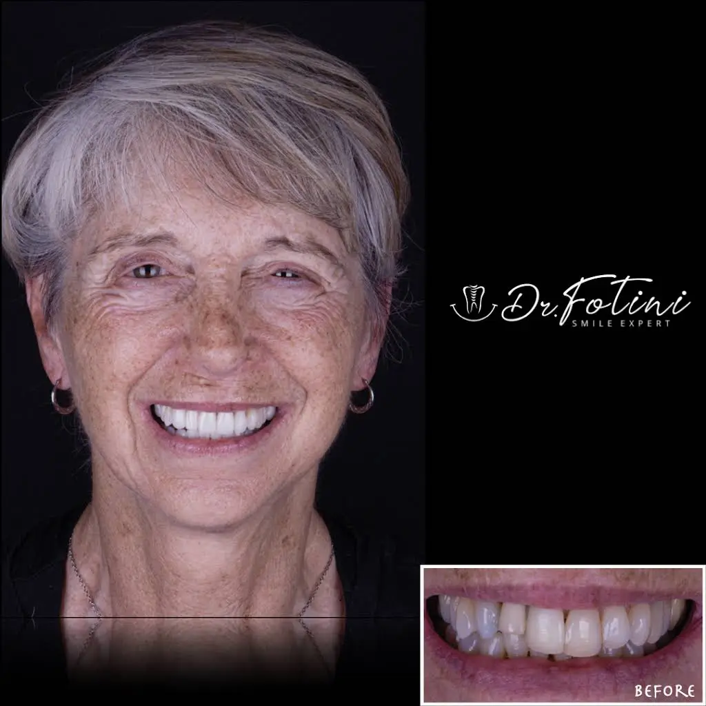 Fotini Chrisopoulos DDS, MS- Prosthodontist | Cosmetic & Implant Dentistry
