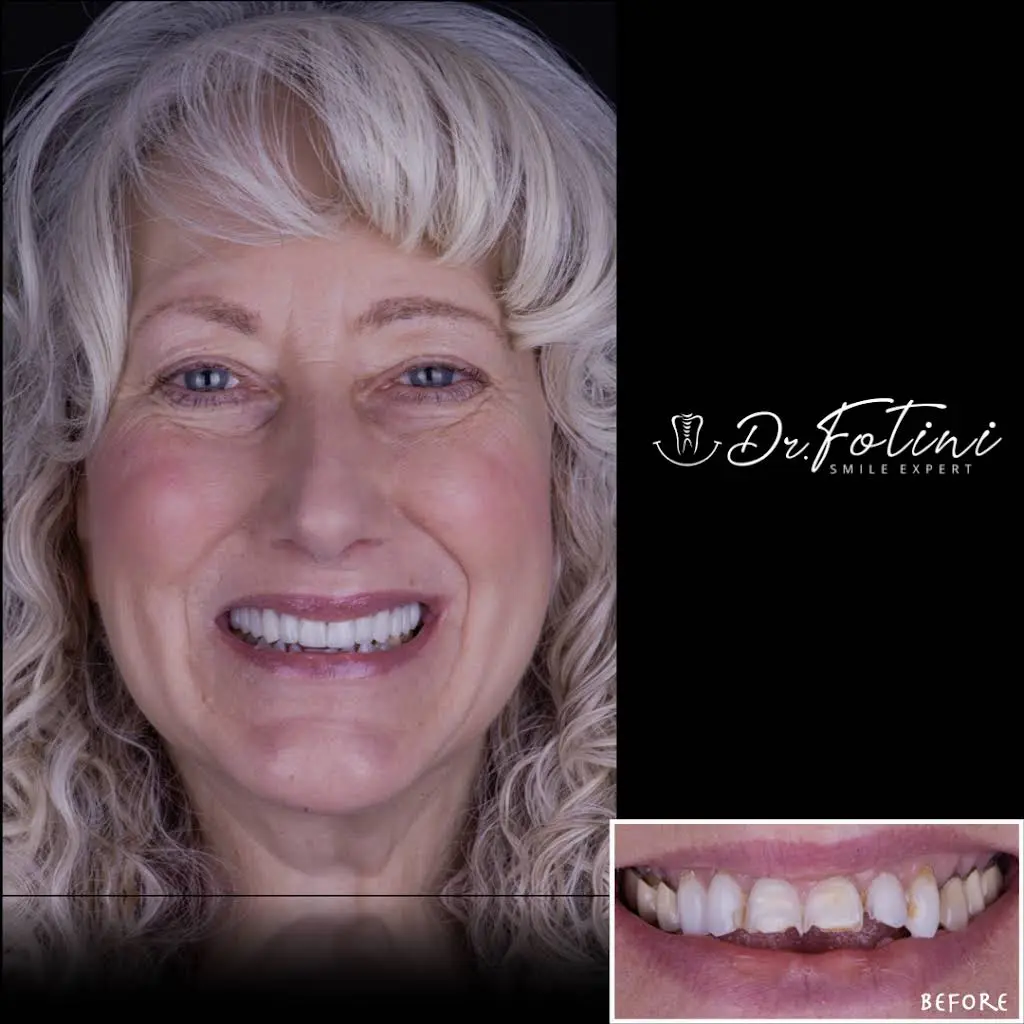Fotini Chrisopoulos DDS, MS- Prosthodontist | Cosmetic & Implant Dentistry