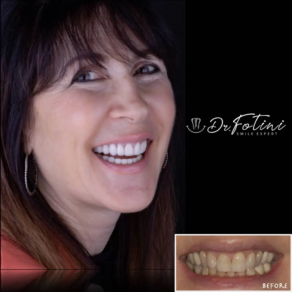 Fotini Chrisopoulos DDS, MS- Prosthodontist | Cosmetic & Implant Dentistry