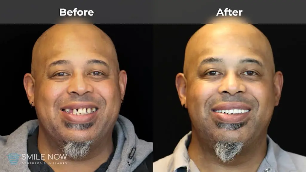 Smile Now Milwaukee Dentures and Implants