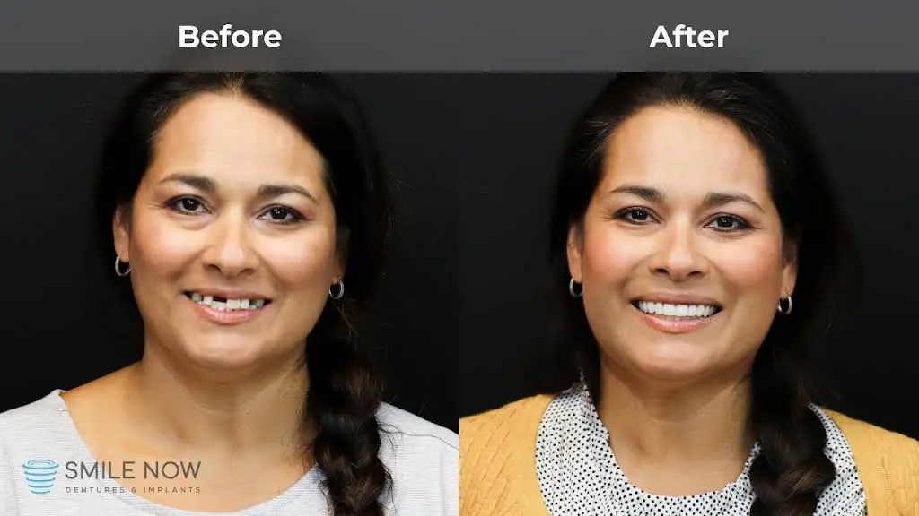 Smile Now Milwaukee Dentures and Implants