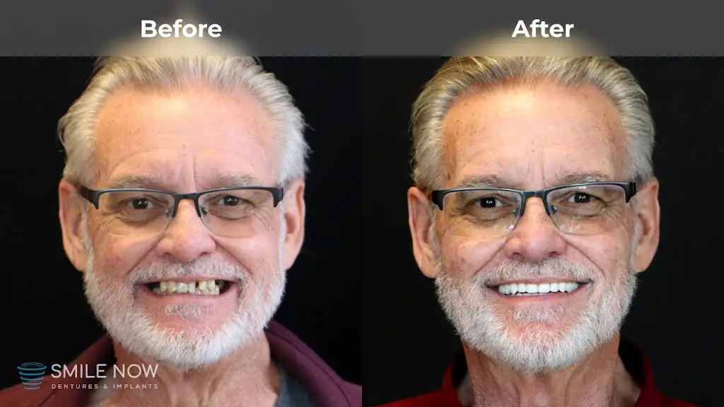 Smile Now Milwaukee Dentures and Implants