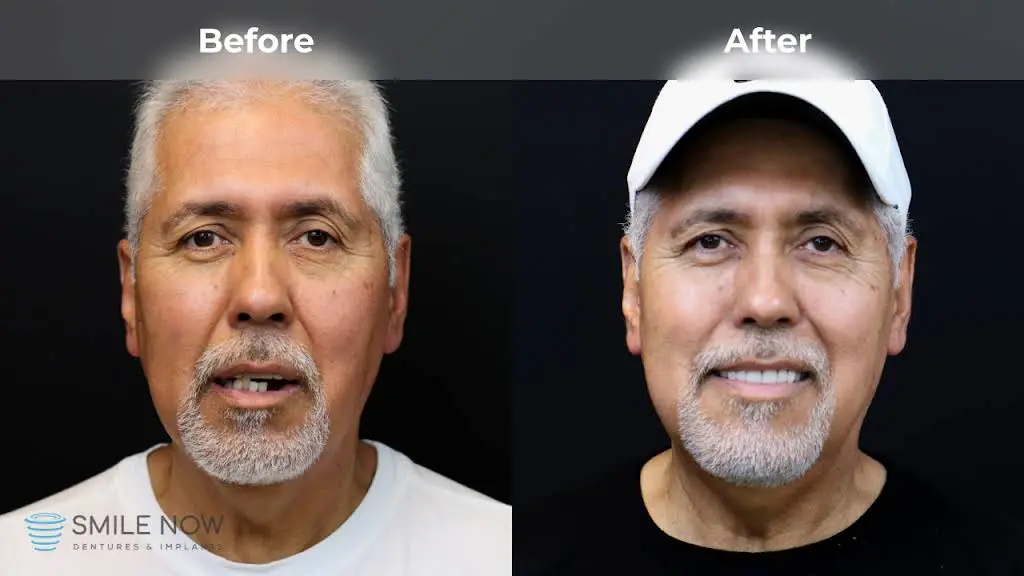 Smile Now Milwaukee Dentures and Implants