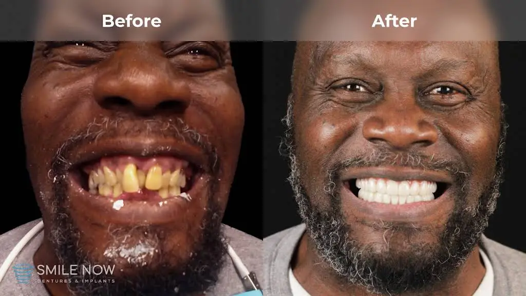 Smile Now Milwaukee Dentures and Implants