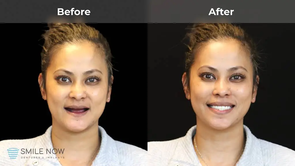 Smile Now Milwaukee Dentures and Implants