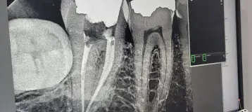 Access Endodontics