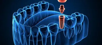 NOVA Center for Periodontics & Dental Implants