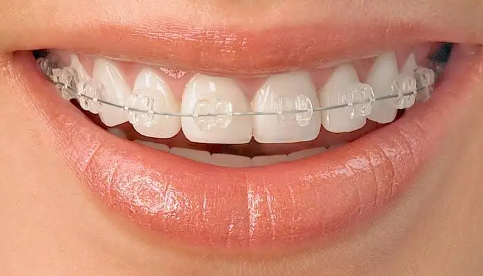 Carpenter Orthodontics - Fred W Carpenter DDS