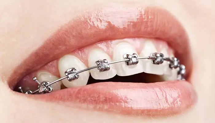 Carpenter Orthodontics - Fred W Carpenter DDS