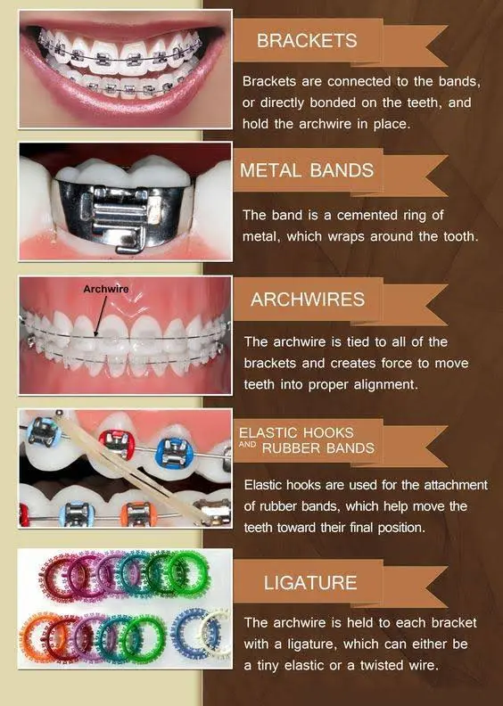 Tacoma Orthodontics - Proctor Braces