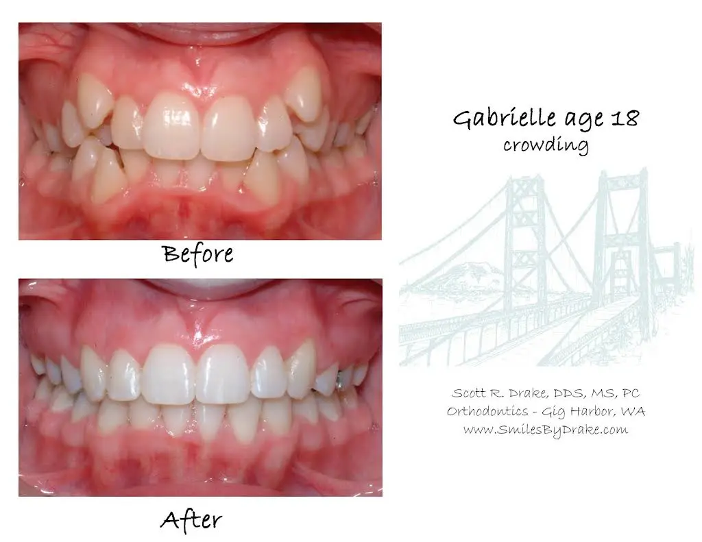 Tacoma Orthodontics - Proctor Braces