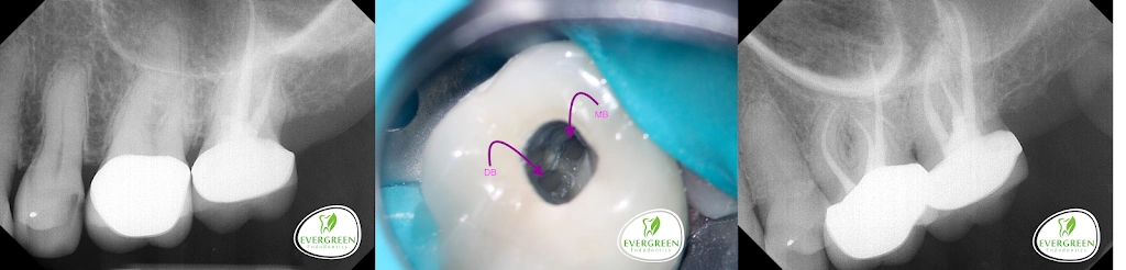 Evergreen Endodontics