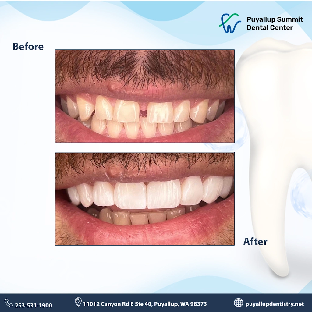 Puyallup Summit Dental Center