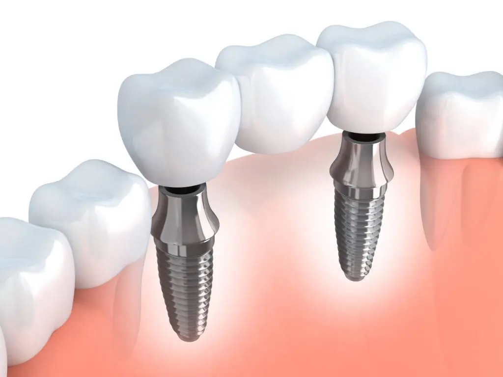 Bismarck Advanced Dental and Implants
