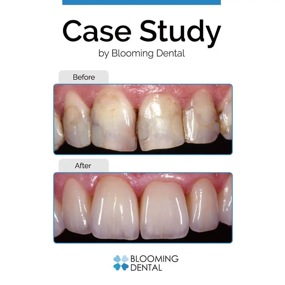 Blooming Dental - Implant & Prosthodontics