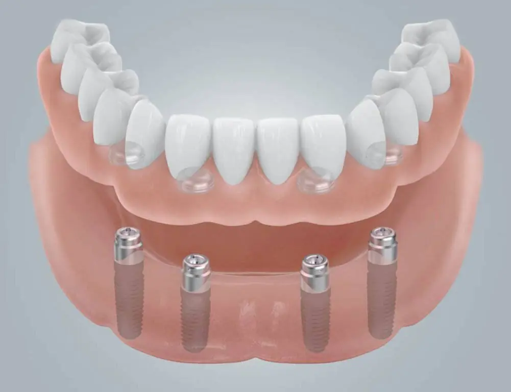 Comfy Denture & Hearing Clinic - Bonney Lake