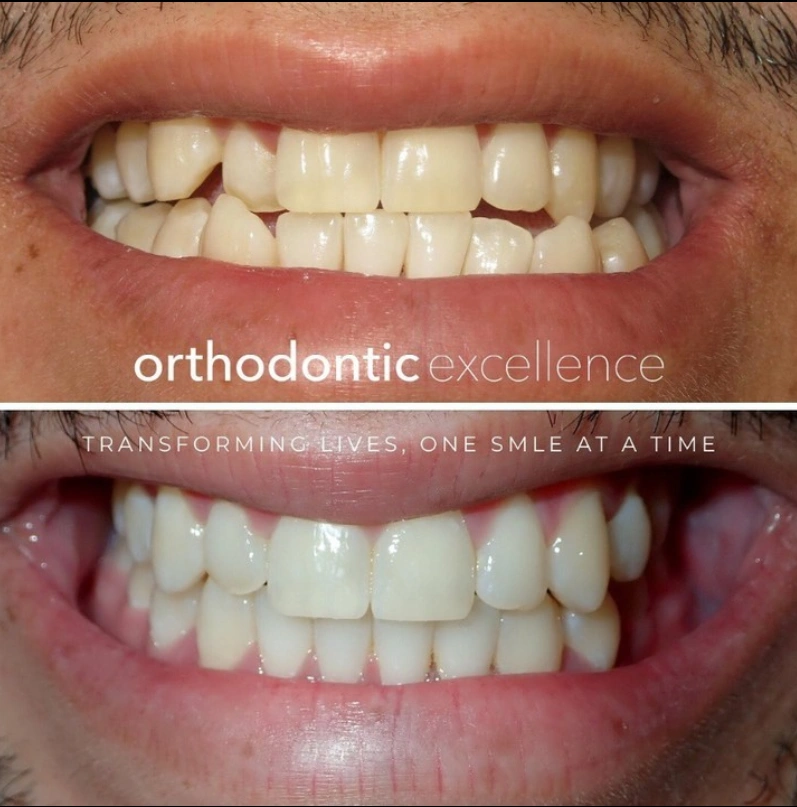 Orthodontic Excellence - Bonney Lake
