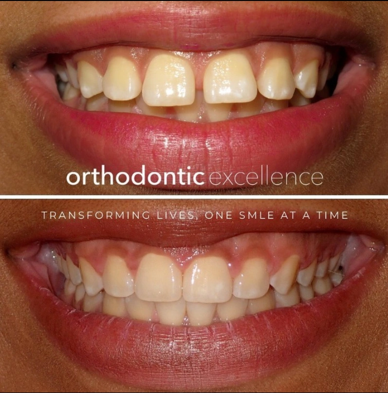 Orthodontic Excellence - Bonney Lake