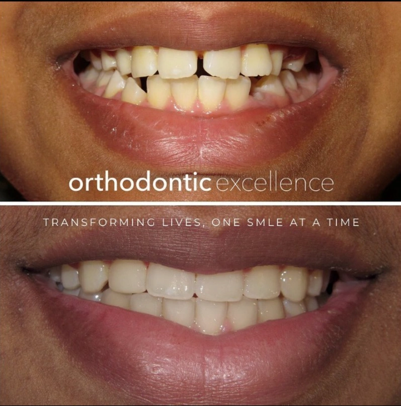 Orthodontic Excellence - Bonney Lake