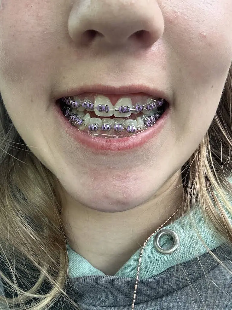 Wire Orthodontics - Liberty Lake