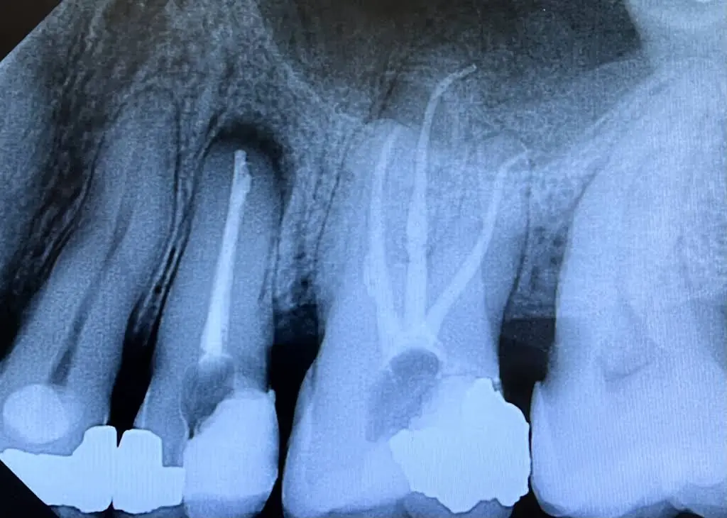 Advanced Endodontics
