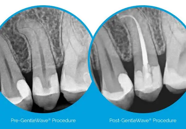 Peak Endodontics - Covington