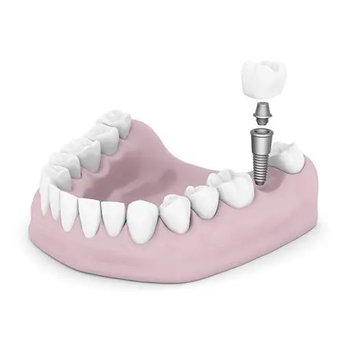 Bay Lakes Center for Complex Dentistry - Escanaba