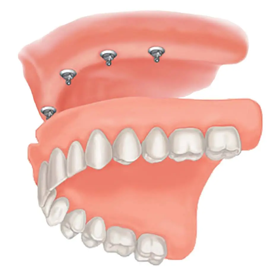 Mini Dental Implant Solutions Gaylord, MI