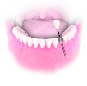 Mini Dental Implant Solutions Gaylord, MI