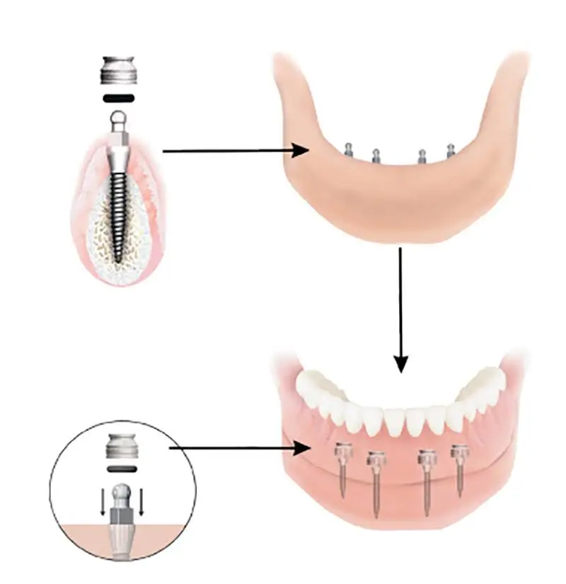 Mini Dental Implant Solutions Gaylord, MI