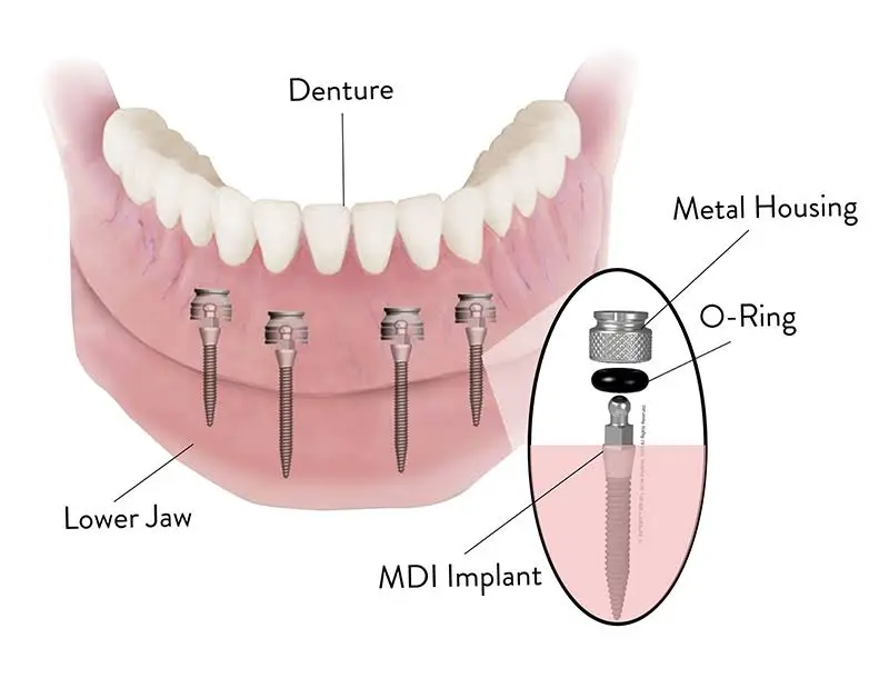 Mini Dental Implant Solutions Gaylord, MI