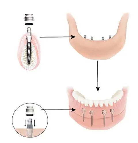 Mini Dental Implant Solutions of Muskegon MI